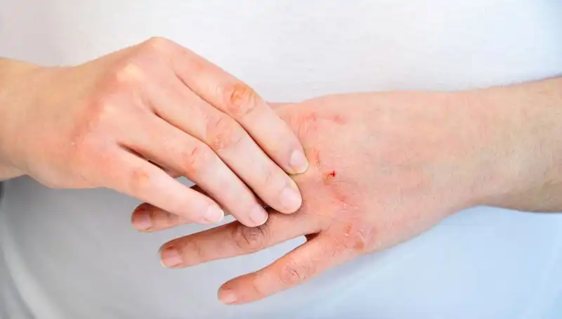 Yetersiz Protein Tüketimi Belirtileri: Hangi Durumlarda Dikkat Etmelisiniz?
